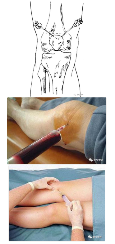 膝关节穿刺术图解图片