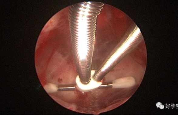 腹腔镜取环手术过程图图片